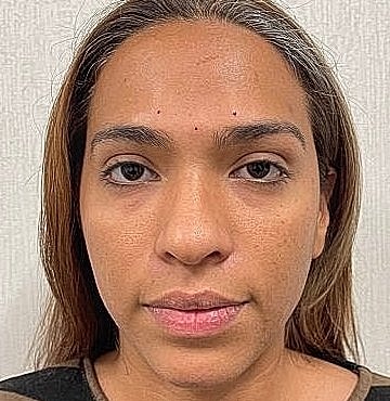 Dermal Filler Before & After