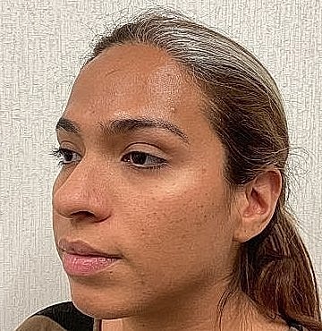 Dermal Filler Before & After