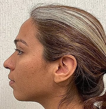 Dermal Filler Before & After