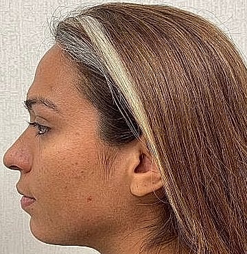 Dermal Filler Before & After