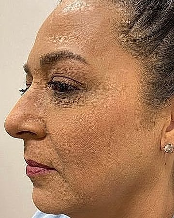 Dermal Filler Before & After