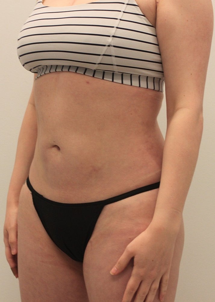 MEDICAL WEIGHT LOSS PROGRAM Before & After