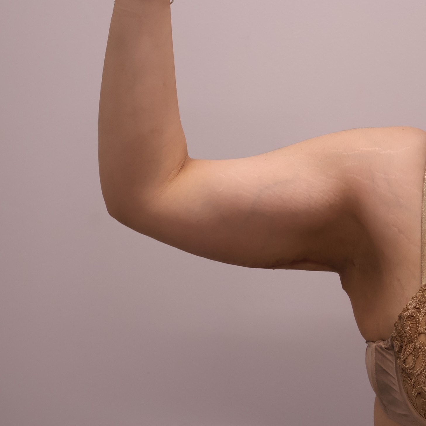 Arm Lift Before & After