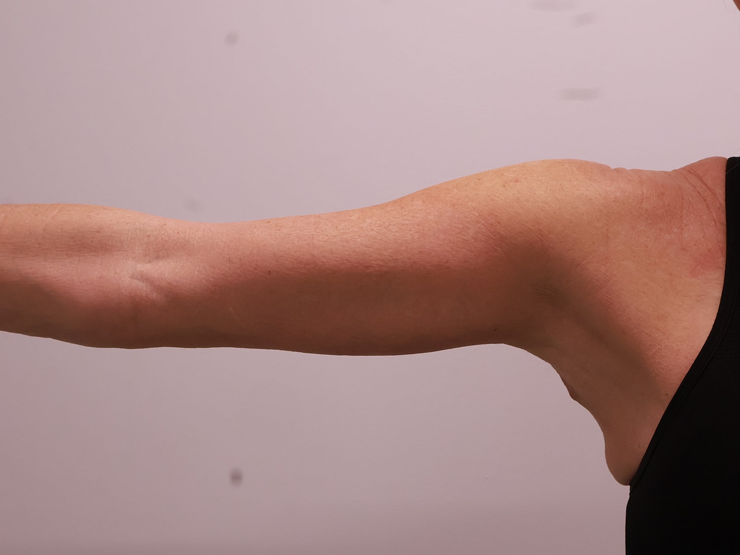 Arm Lift Before & After