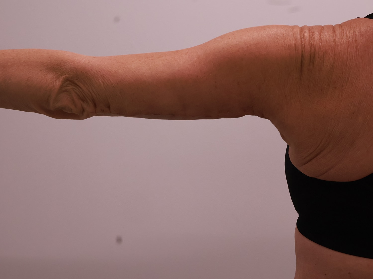 Arm Lift Before & After