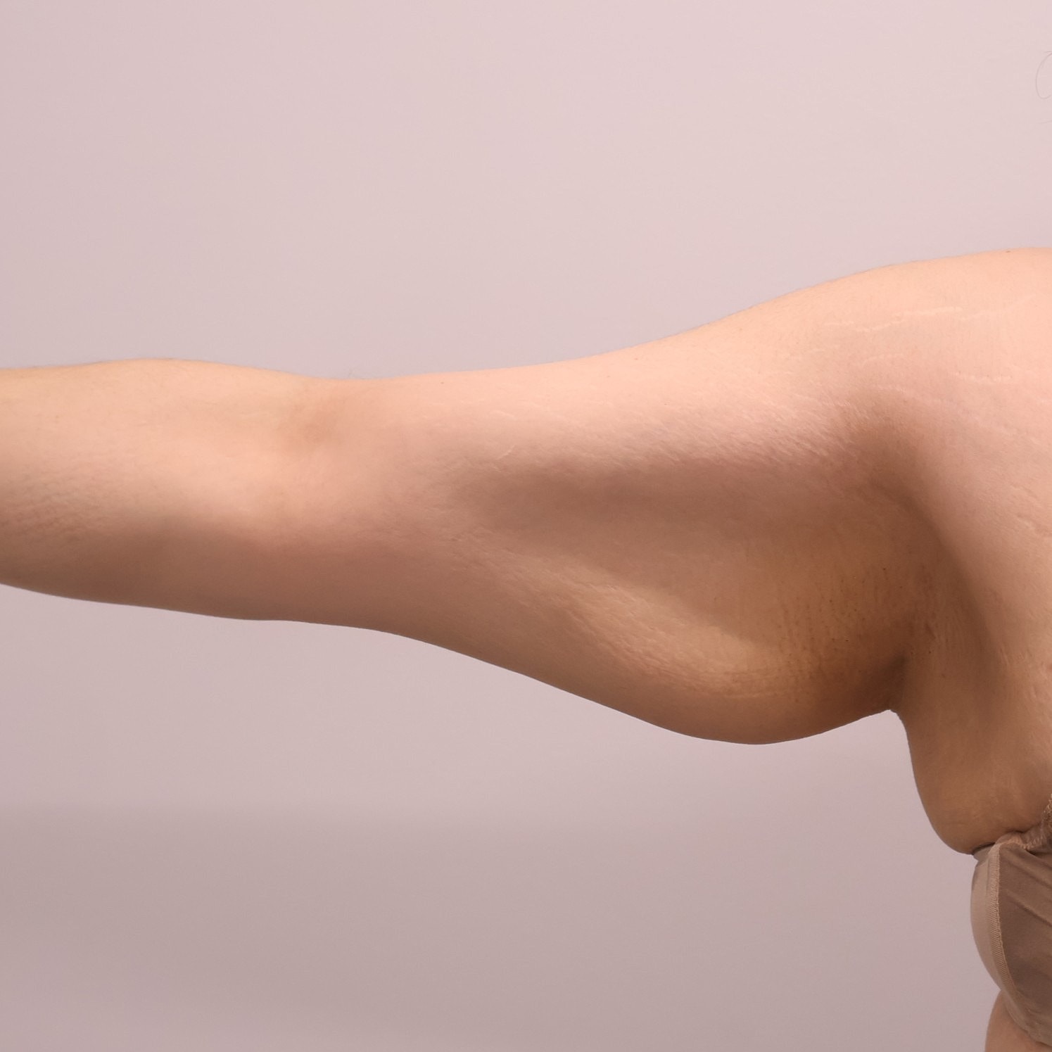 Arm Lift Before & After