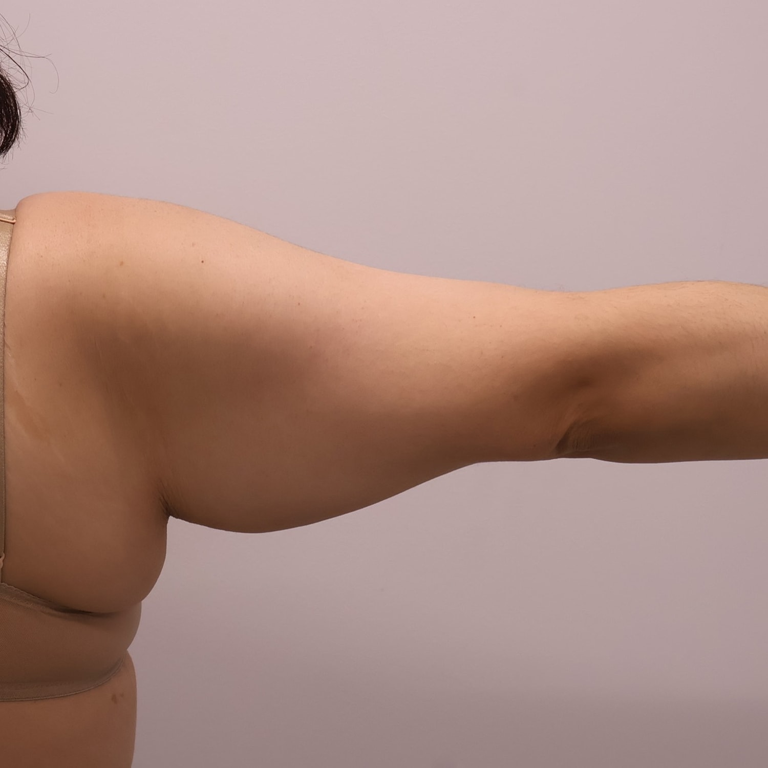 Arm Lift Before & After