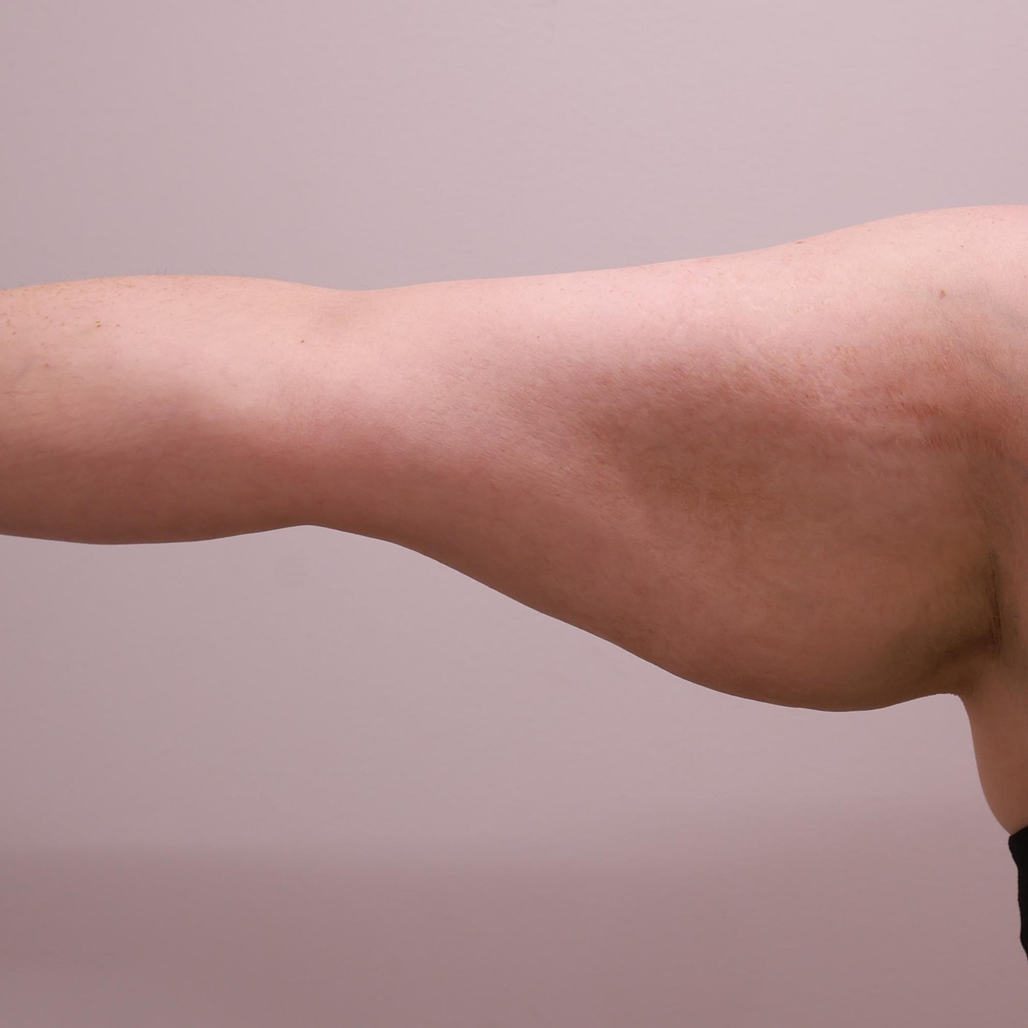 Arm Lift Before & After