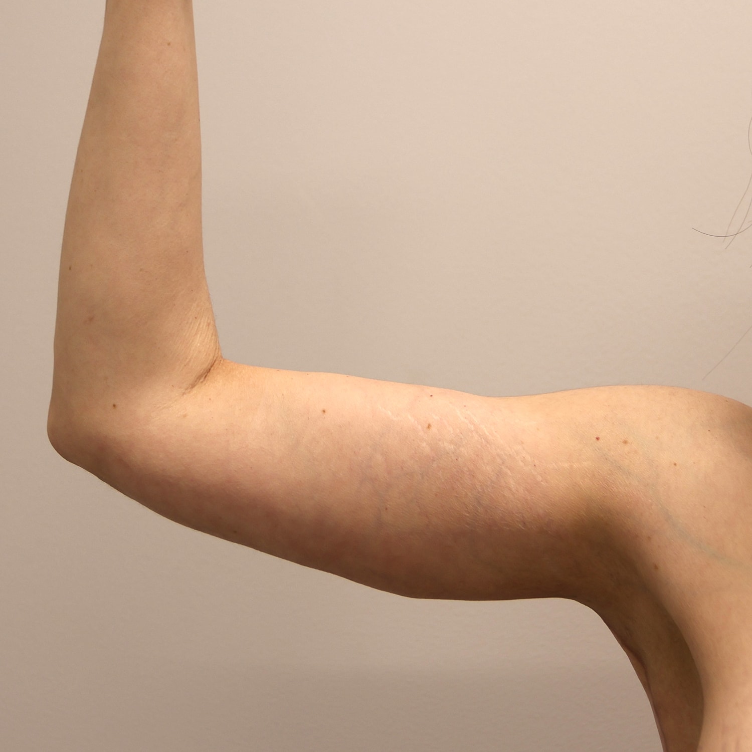 Arm Lift Before & After