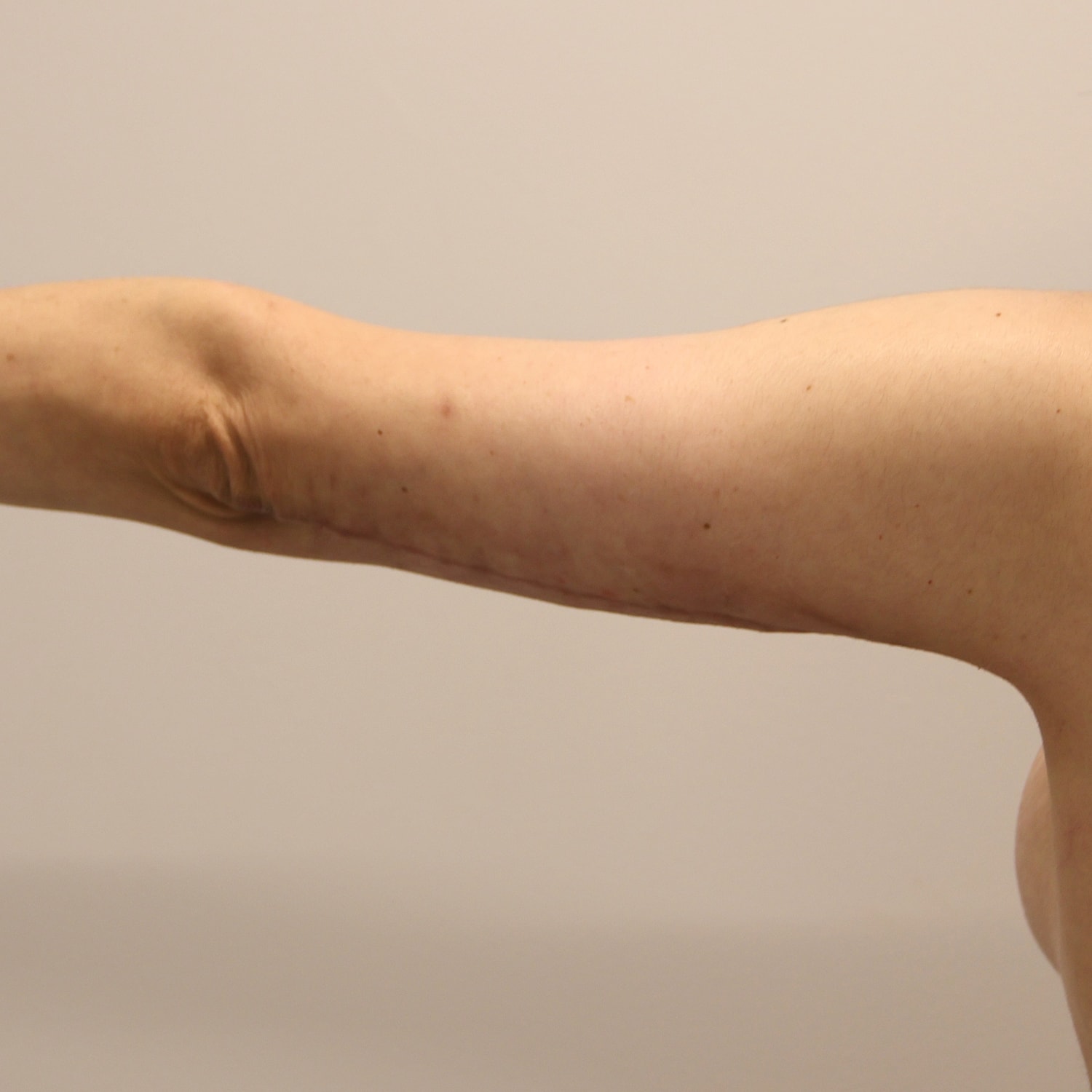 Arm Lift Before & After