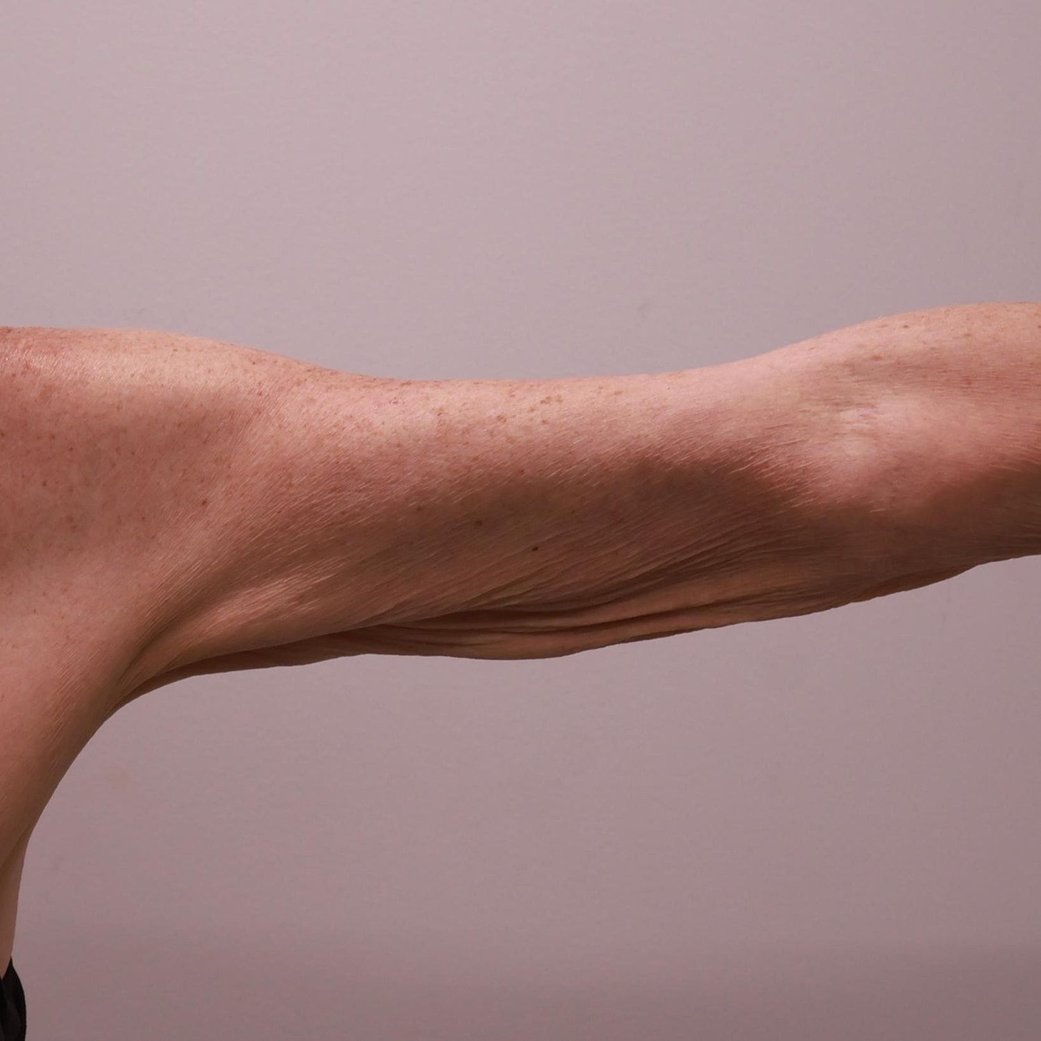 Arm Lift Before & After