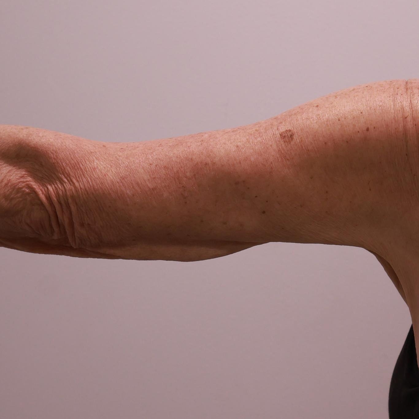 Arm Lift Before & After