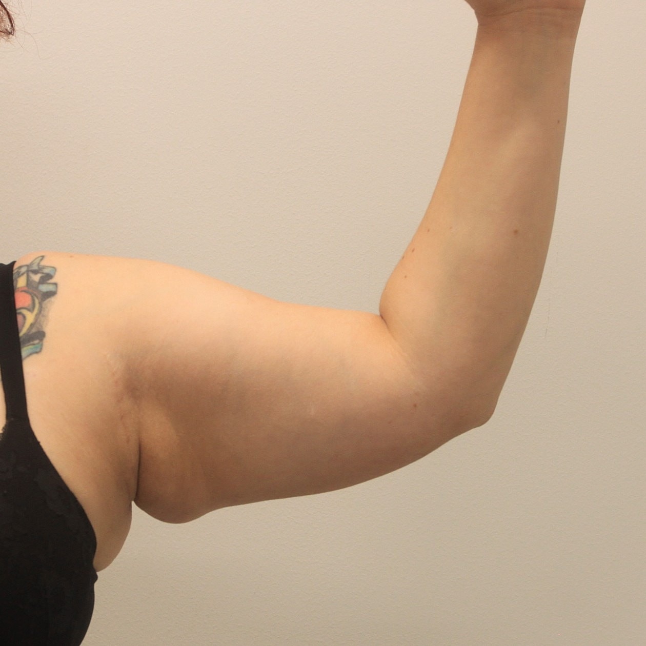 Arm Lift Before & After