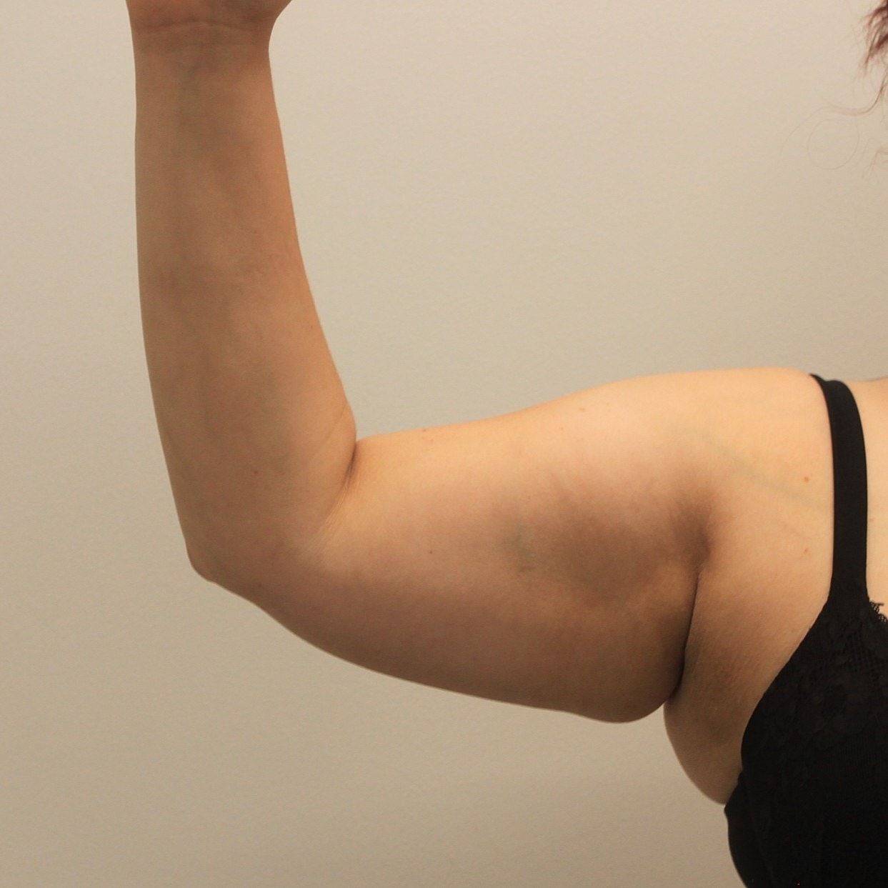 Arm Lift Before & After