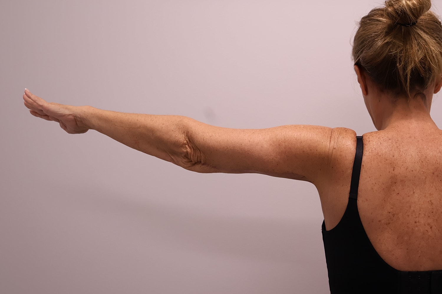 Arm Lift Before & After