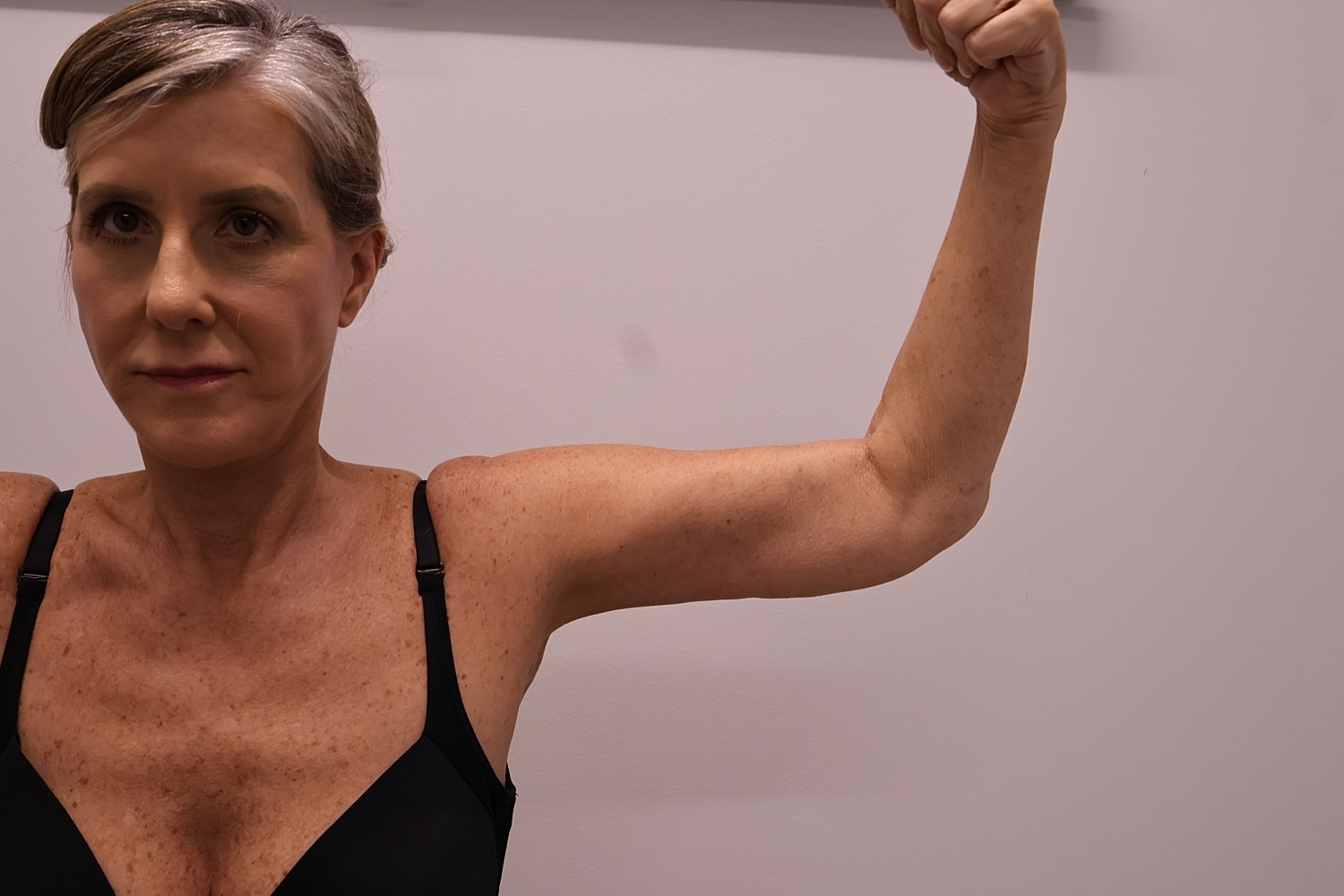 Arm Lift Before & After