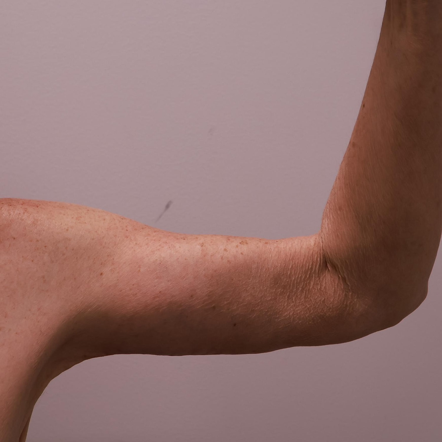 Arm Lift Before & After