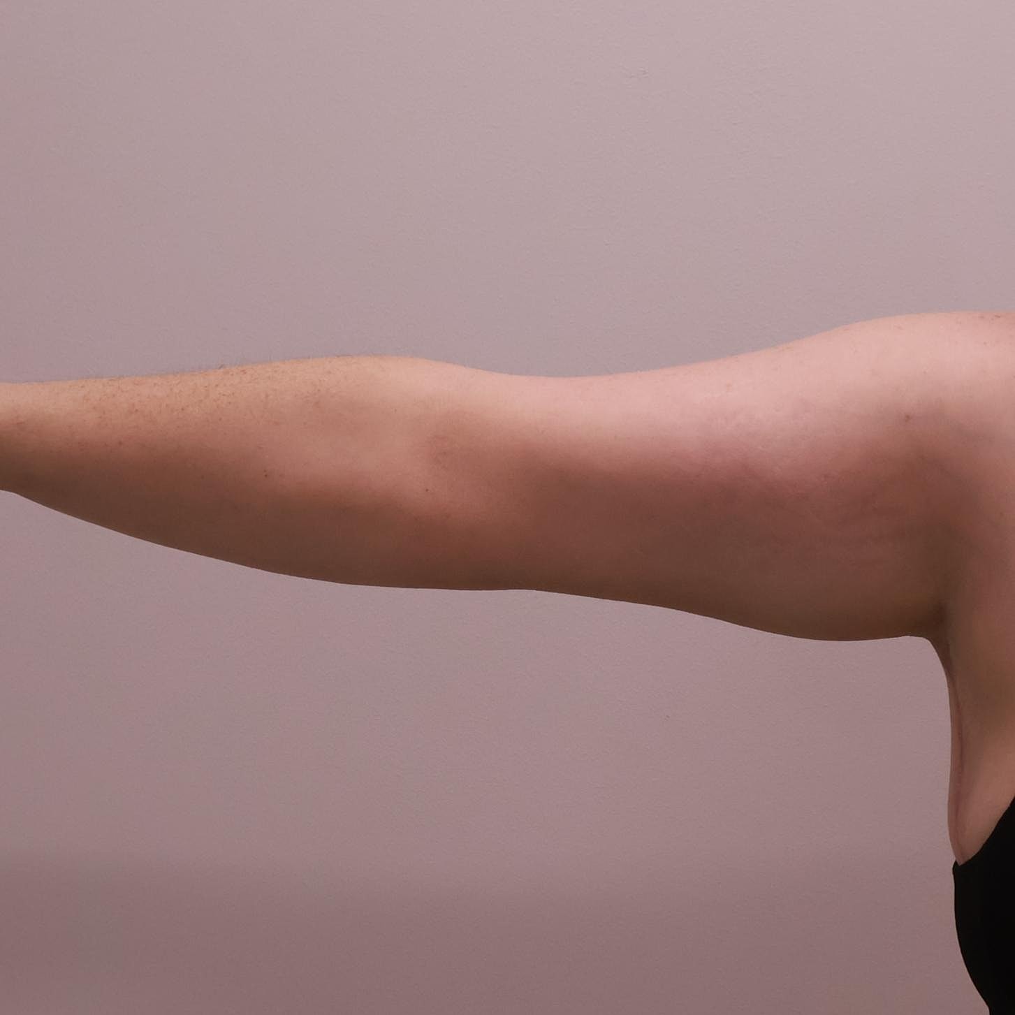 Arm Lift Before & After