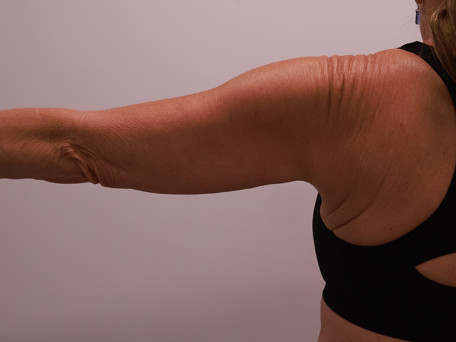 Arm Lift Before & After