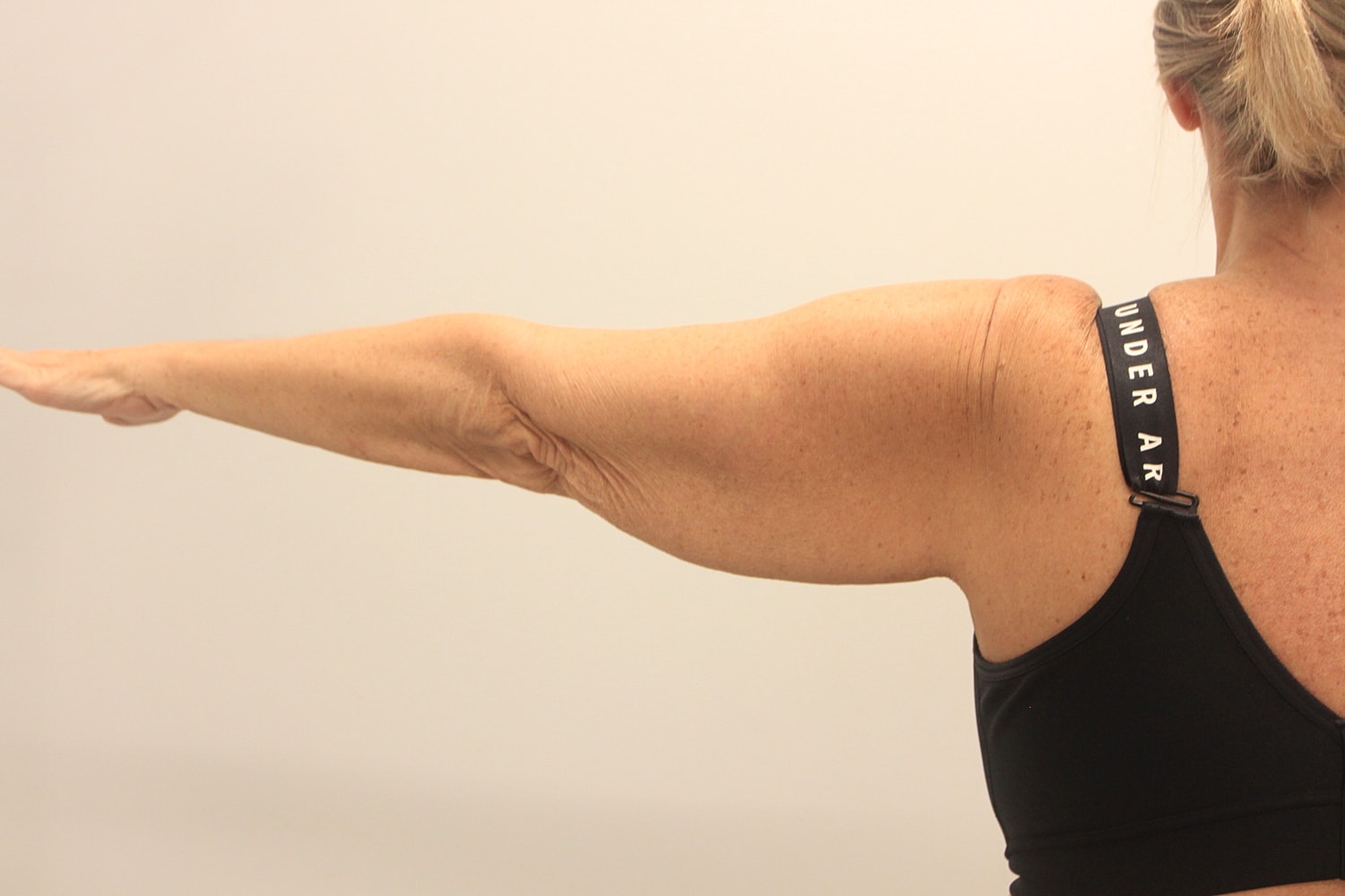 Arm Lift Before & After