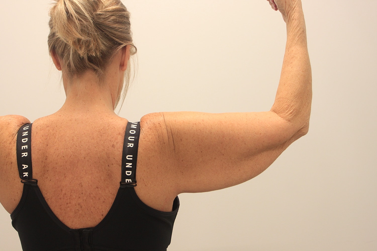 Arm Lift Before & After