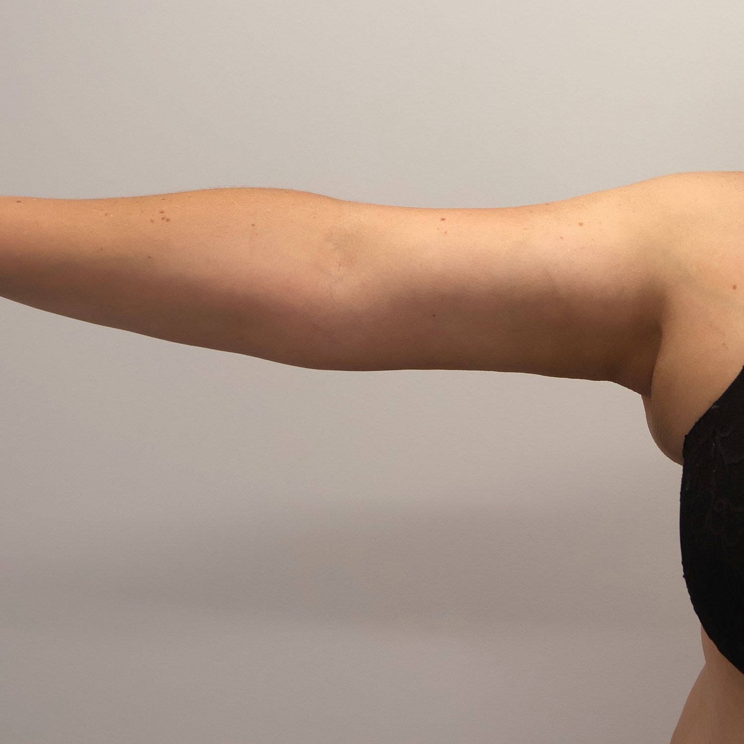 Arm Lift Before & After