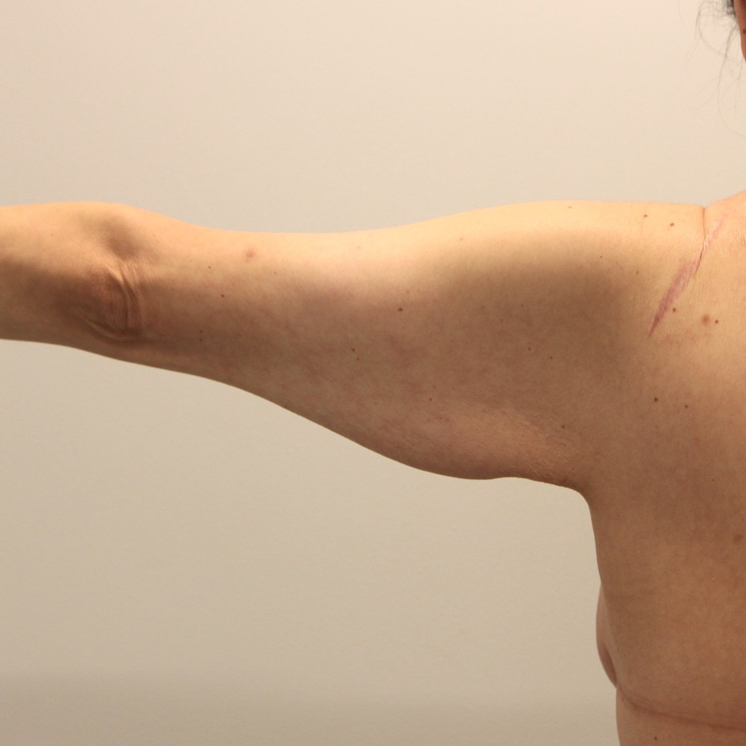 Arm Lift Before & After