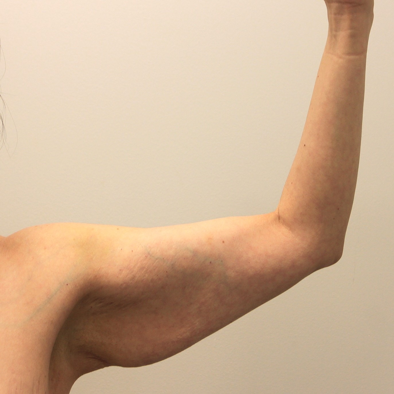 Arm Lift Before & After