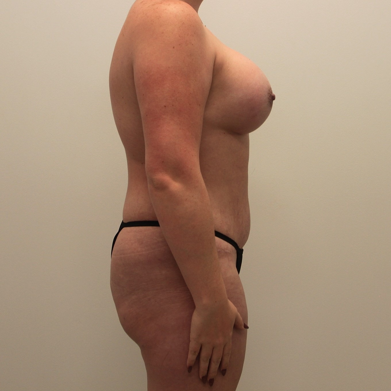 Mommy Makeover Before & After