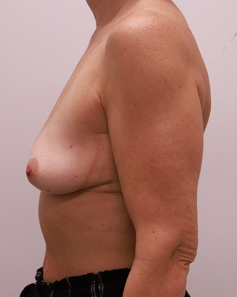 Breast Lift Before & After