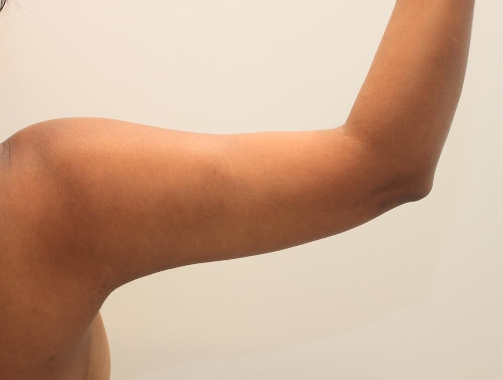 Arm Liposuction Before & After