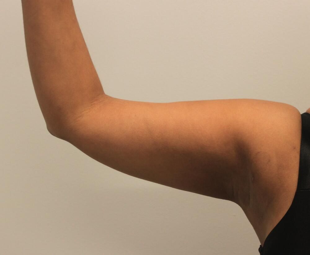 Arm Liposuction Before & After