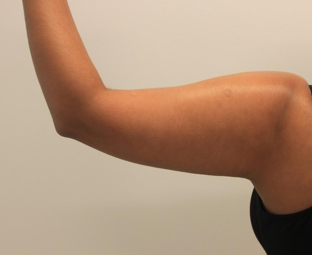 Arm Liposuction Before & After