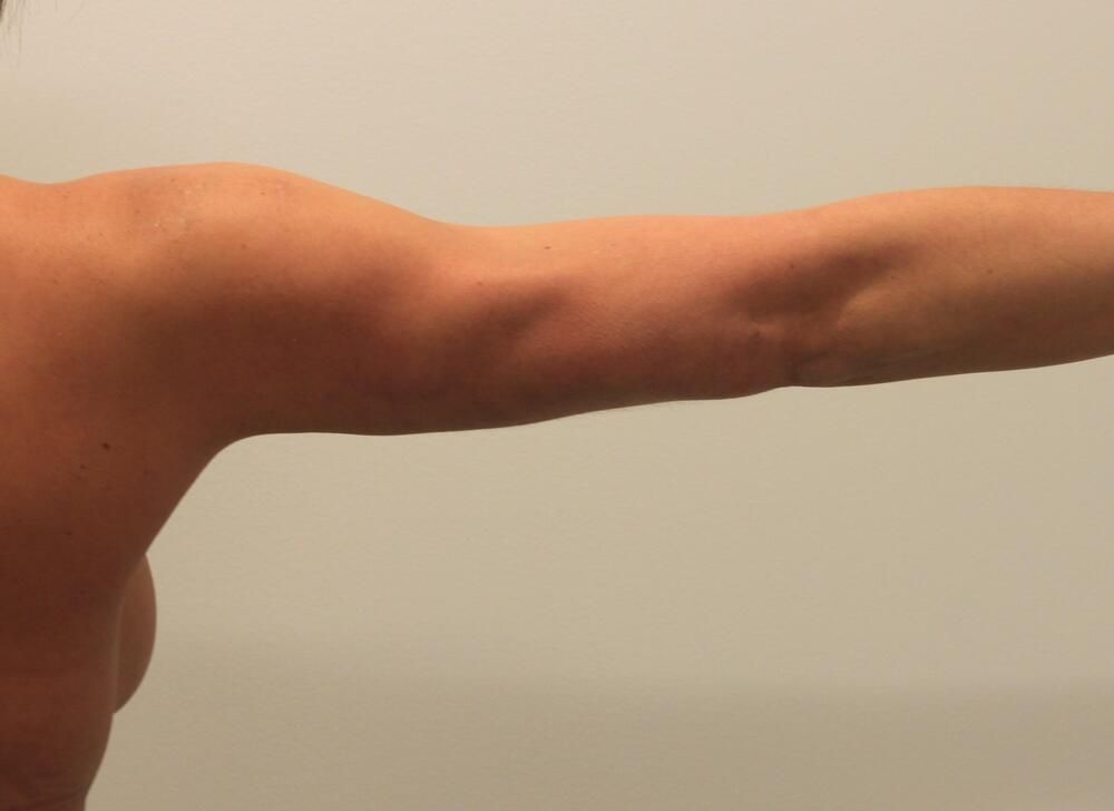 Arm Liposuction Before & After