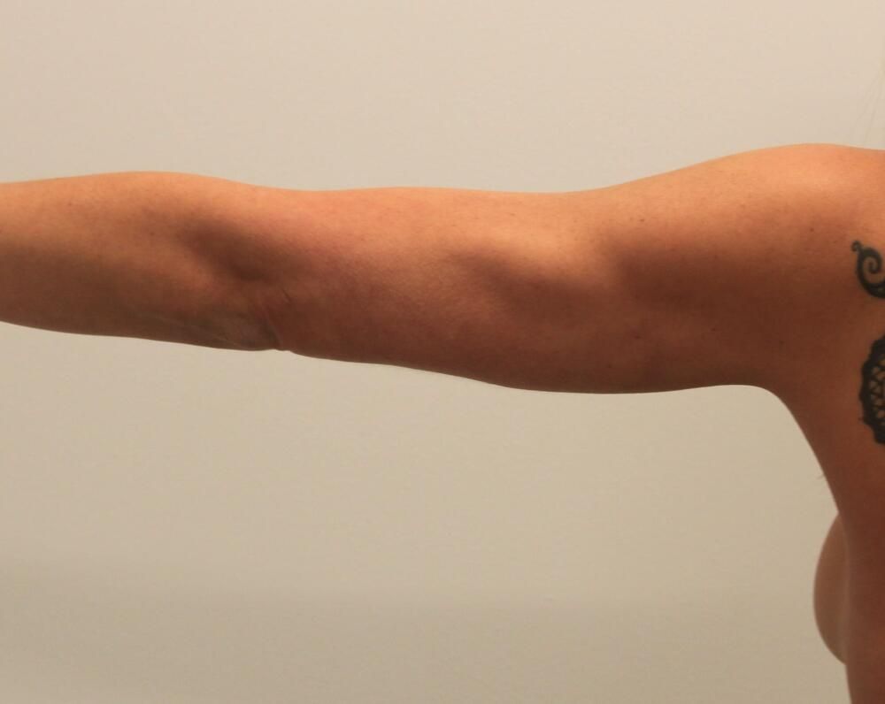 Arm Liposuction Before & After
