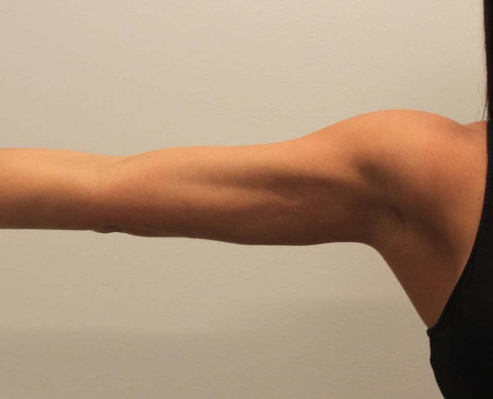 Arm Liposuction Before & After