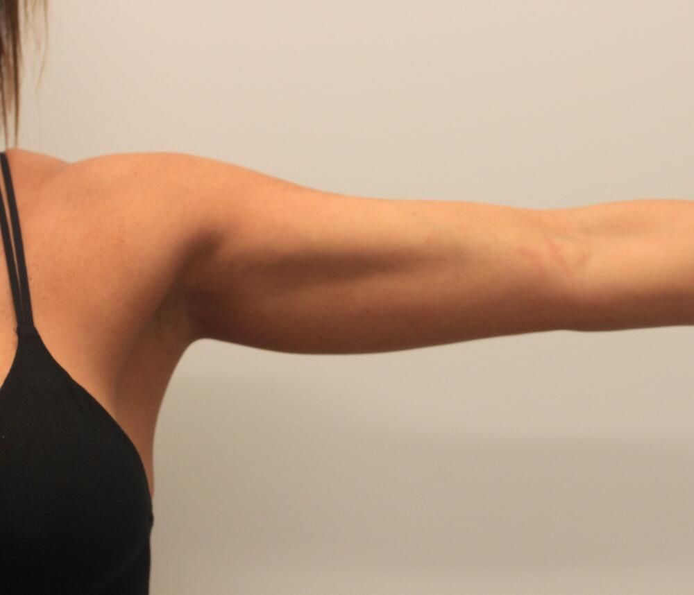 Arm Liposuction Before & After