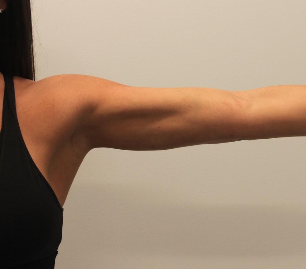 Arm Liposuction Before & After