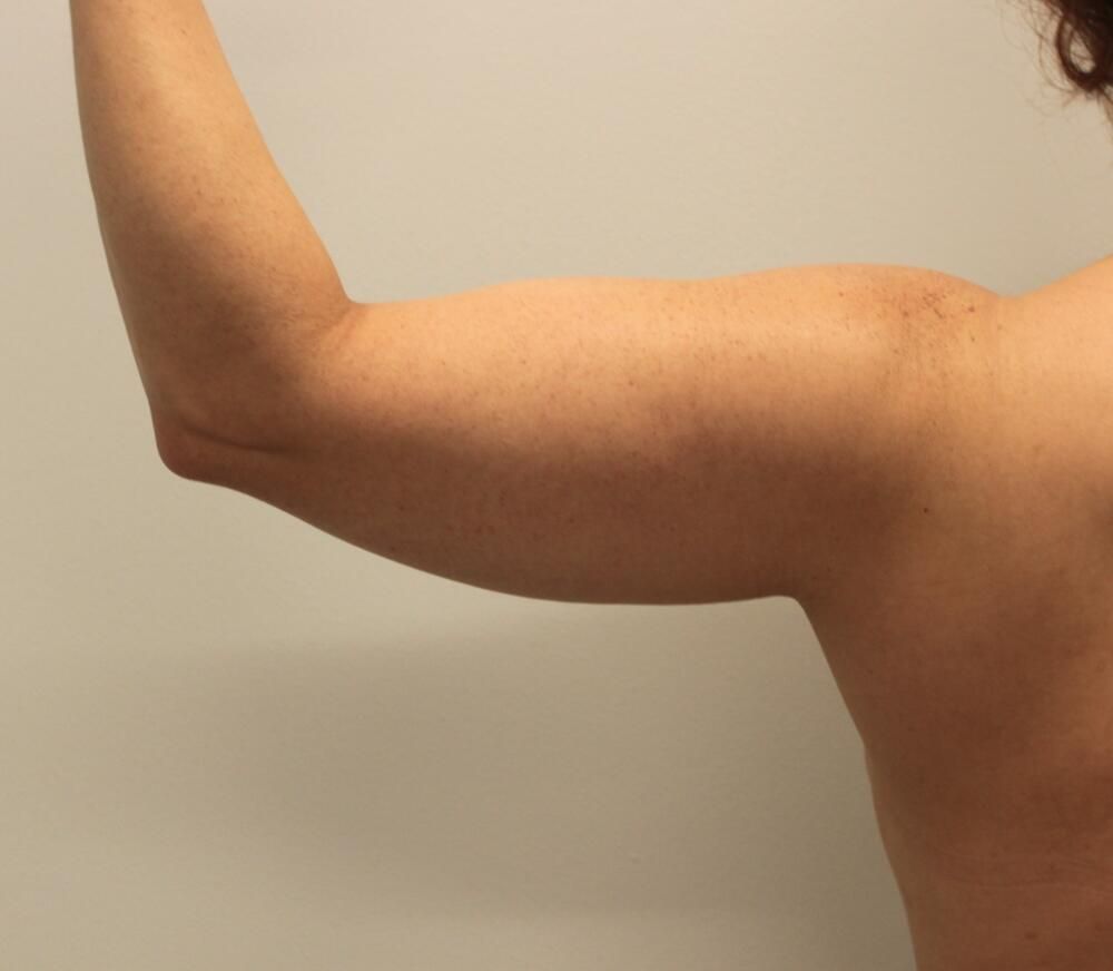 Arm Liposuction Before & After