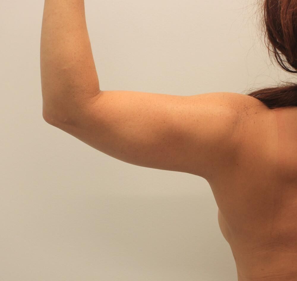 Arm Liposuction Before & After