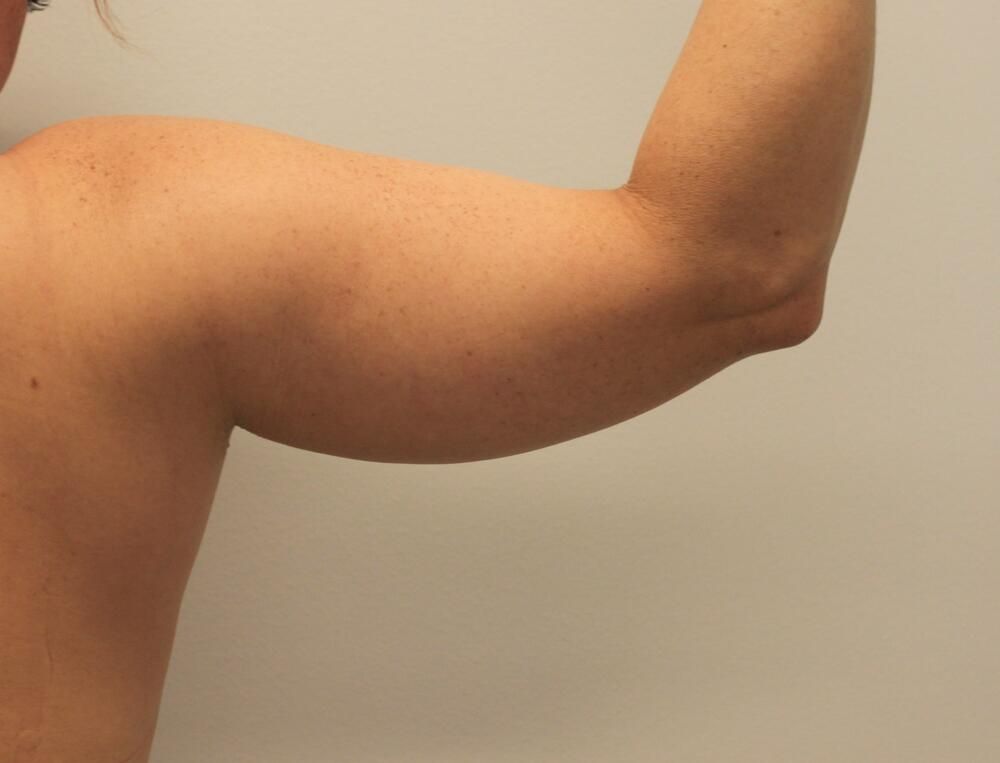 Arm Liposuction Before & After