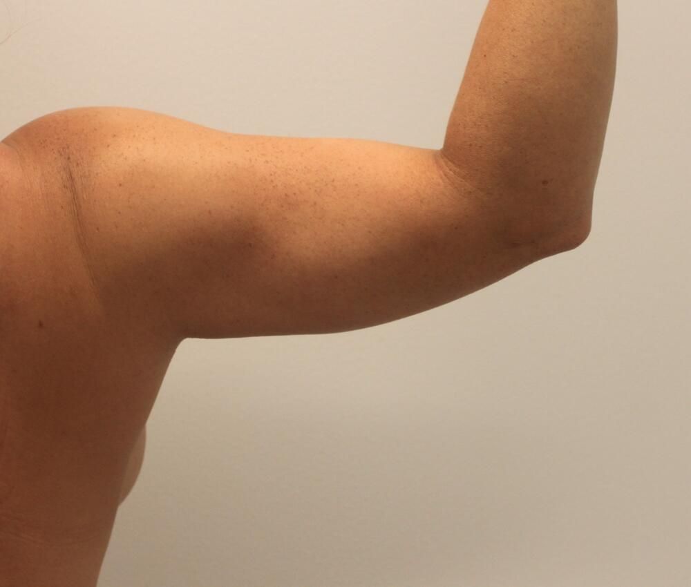 Arm Liposuction Before & After