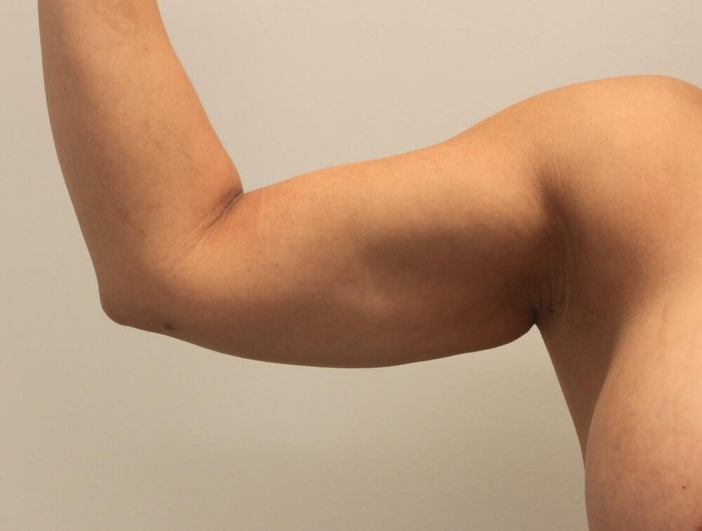 Arm Liposuction Before & After