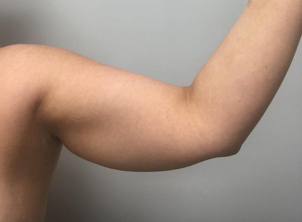 Arm Liposuction Before & After