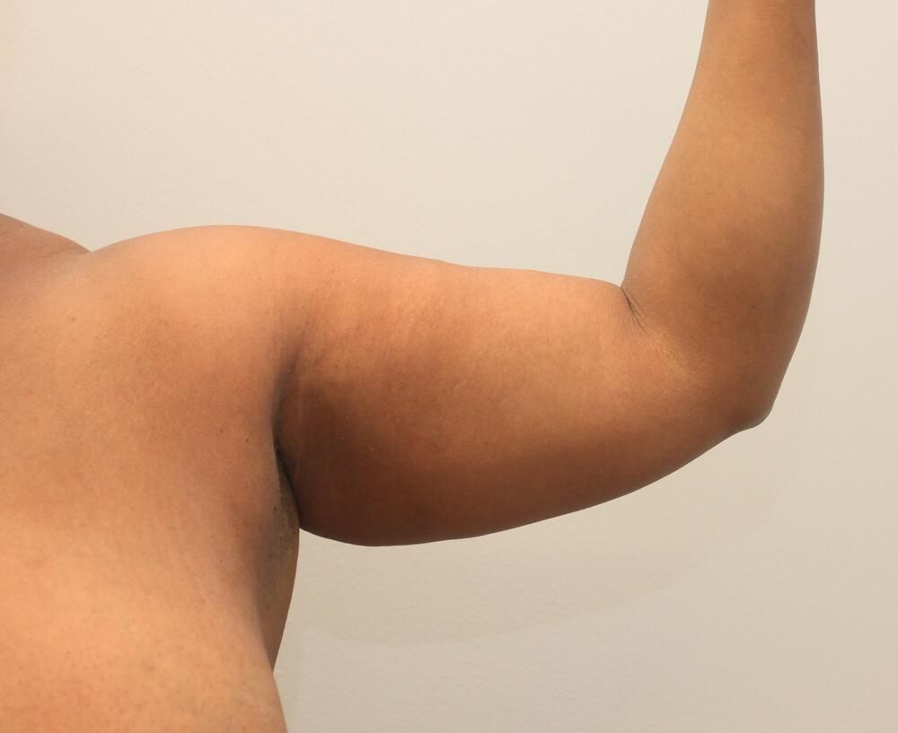 Arm Liposuction Before & After