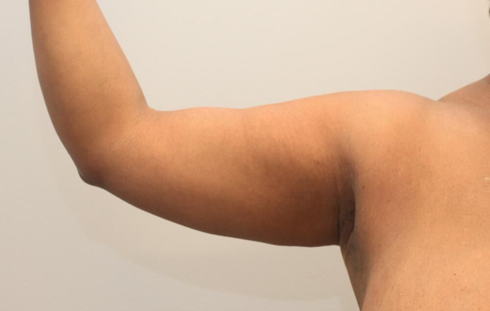 Arm Liposuction Before & After