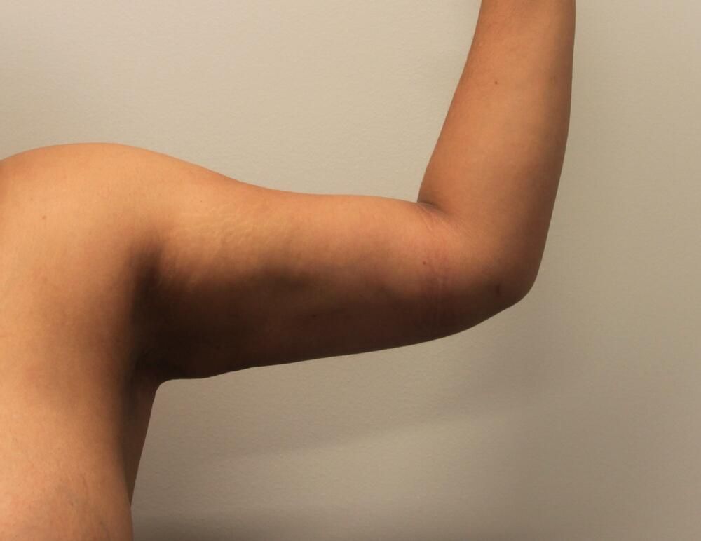 Arm Liposuction Before & After