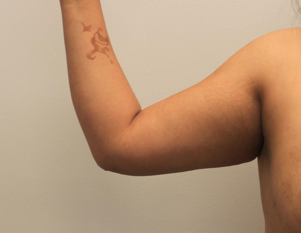 Arm Liposuction Before & After