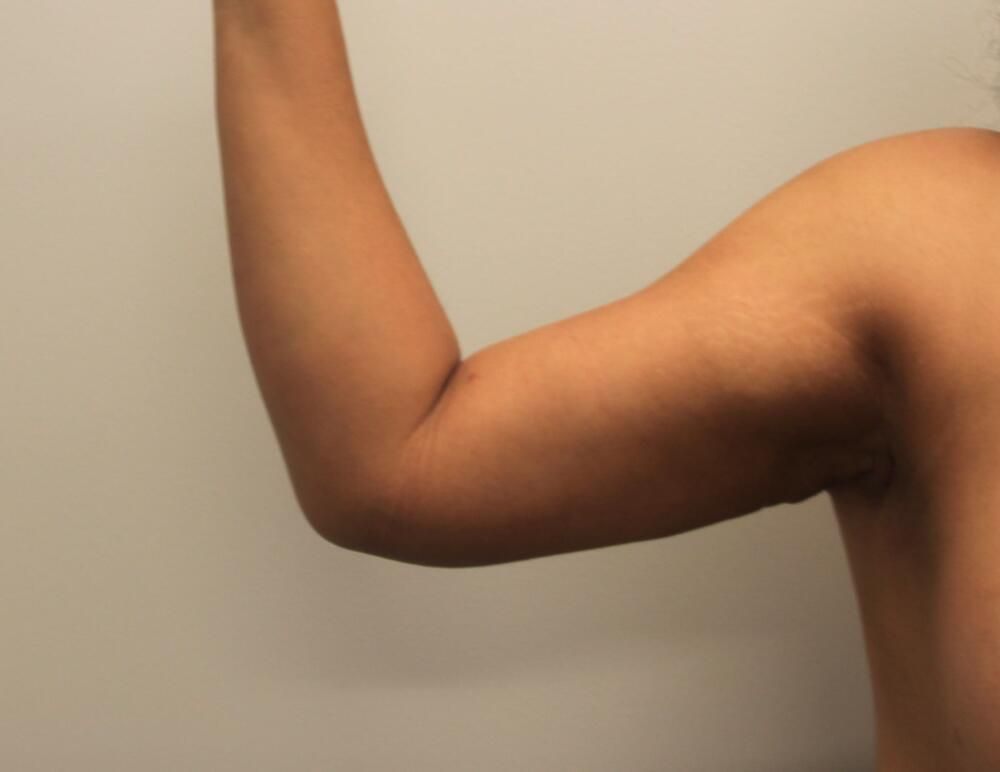 Arm Liposuction Before & After