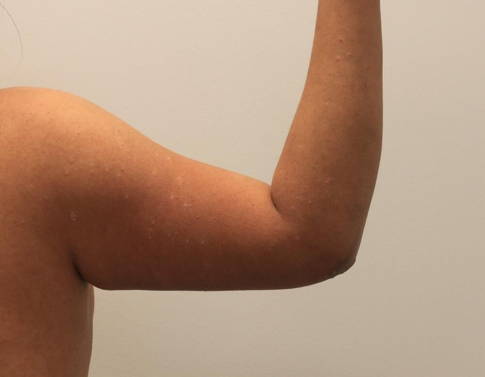 Arm Liposuction Before & After